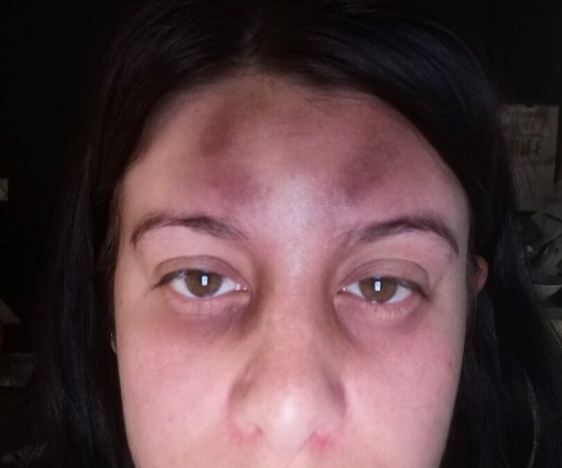 Sheffield mother who suffered “horrendous” domestic violence attack speaks out